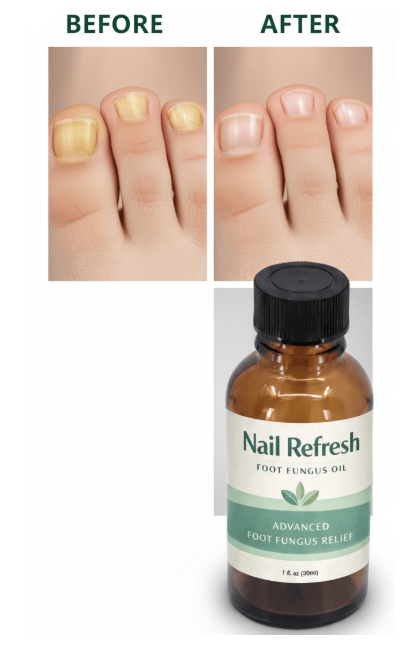 Nail Refresh Foot Fungus Oil